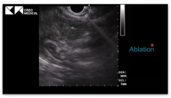 An image of the instrument under ultrasound guidance. Energy is being applied in a controlled fashion through a minimally invasive approach.