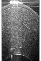 Bydd yr astudiaeth yn asesuw datblygu ac archwilio datblygiad clinigol dyfais Ultra-Sensitive OCT (US-OCT) sydd yn crey delweddau fel hyn.  