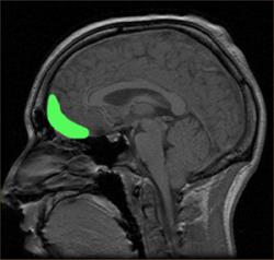  MRI scan showing approximate location of the orbitofrontal cortex. : Wikimedia/Paul Wicks